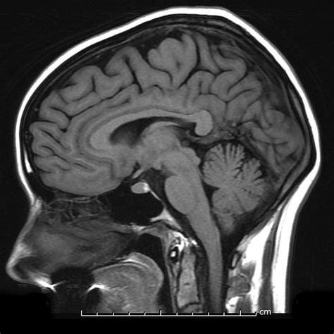 Normal Midline Brain Mri Image