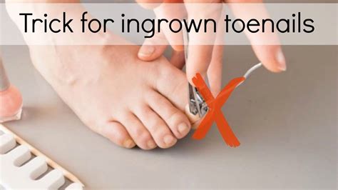 How To Get Rid Of An Ingrown Toenail At Home T