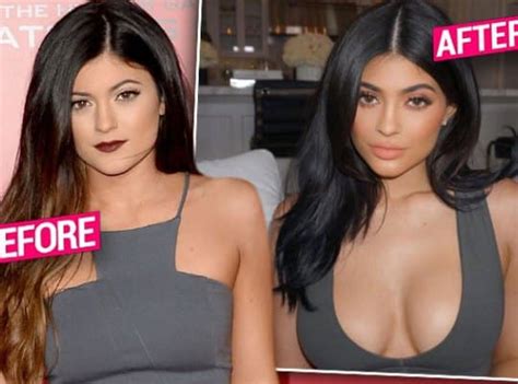 Kylie Jenner Body Before And After Plastic Surgery