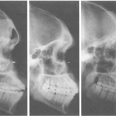 Lateral Skull Radiographs Showing The Independence Of The Frontal Torus