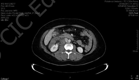 Ct Scan Of The Abdomen Axial Section Showing A Retroperitoneal