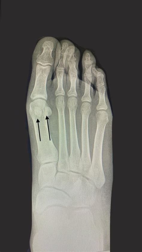 Haglund S Deformity Chelsea Foot And Ankle