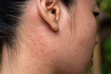 Eczema On The Face Symptoms Causes And Treatment Bodewell