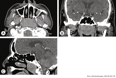 Primary Mantle Cell Lymphoma Of The Nasopharynx A Rare Clinical Entity