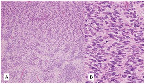 Malignant Peripheral Nerve Sheath Tumor In The Anterior Mediastinum A