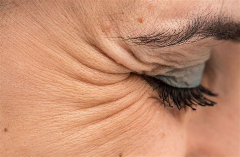 How To Get Rid Of Crows Feet Without Botox