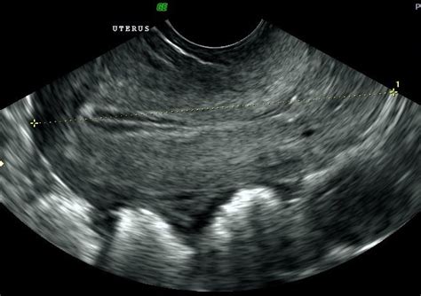 Pelvic Ultrasound Scans For Women In London Ultrasound Services