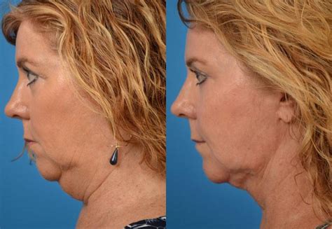 Patient 122406514 Laser Assisted Weekend Neck Lift Before And After