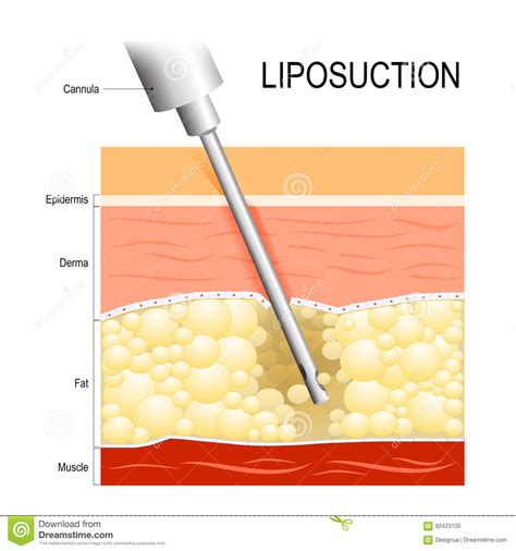 Liposuction Cannula Into The Fat Layer Beneath Skin Stock Vector