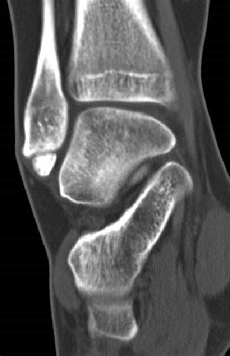 Accessory Ossicle The Foot And Ankle Online Journal