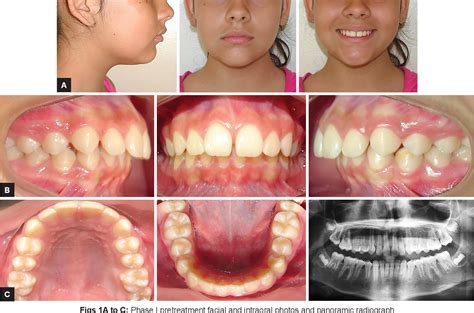 Class Ii Division 1 Malocclusion Treated With The Andresen Appliance