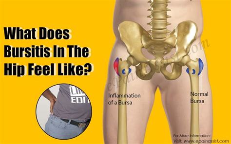 What Does Bursitis In The Hip Feel Like Bursitis Bursitis Hip Hip