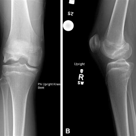 Initial Presenting Right Knee Radiographs Showing An Ocd Lesion Of The