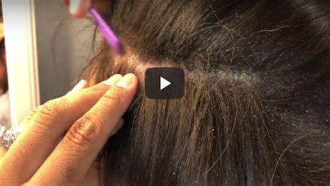 Dandruff Scraping Videos Have Taken Over Pimple Popping As The Most