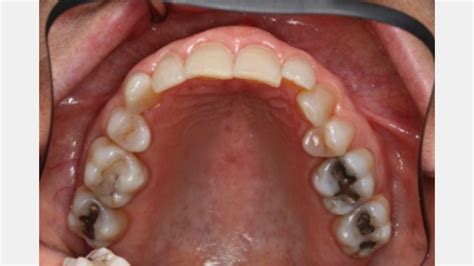 Maxillary First Premolar Extractions For Orthodontics A Red Flag For
