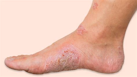 Symptoms Causes Types And Treatment Of Diabetic Foot Ulcers Onlymyhealth