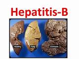Pictures of Hepatitis B Cancer Treatment