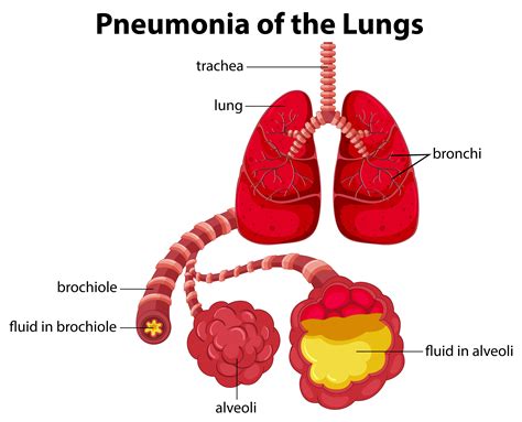 Pneumonia Of The Lungs Diagram 433937 Vector Art At Vecteezy