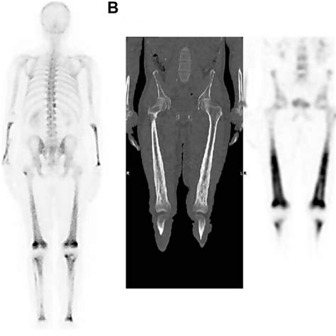 Full Body Bone Scintigraphy And Single Photon Emission Computed