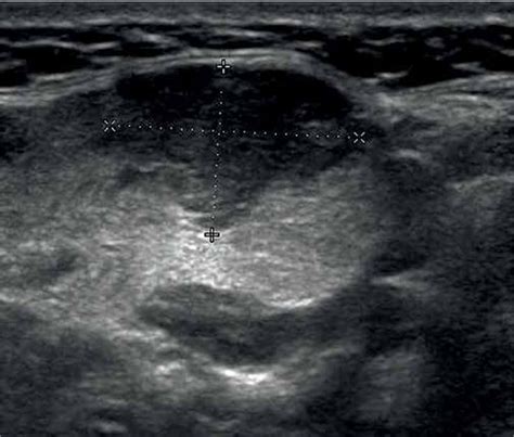 Submandibular Gland Ultrasound
