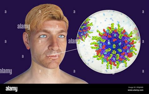 Cold Sore On The Lip Of A Man And Closeup View Of Herpes Simplex