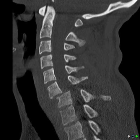 Bilateral Cervical Locked Facets Radiology Dislocation Cervical