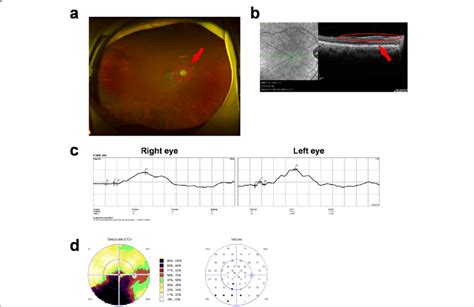 Ophthalmologic Examinations Of The Right Eye At Follow Up Visits To