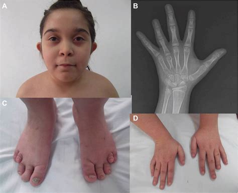 Figure 1 From Brachydactyly Mental Retardation Syndrome In Differential