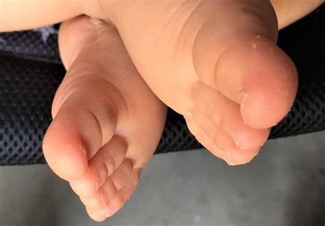 ハイハイする赤ちゃんの足の皮がむける!?なにか対策はいる ...