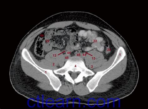 Anatomy Ct Axial Abdomen And Pelvis Male
