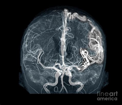 Cerebral Arteriovenous Malformation Photograph By Zephyrscience Photo Library