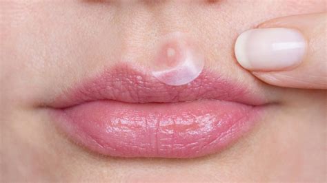 What Causes Lip Acne And How You Can Prevent It