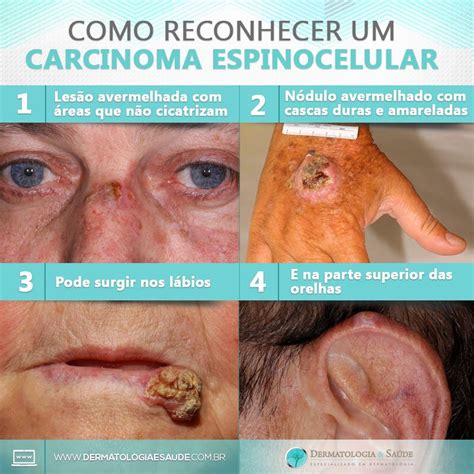 Carcinoma Espinocelular Carcinoma Espinocelular Oncologista Em São