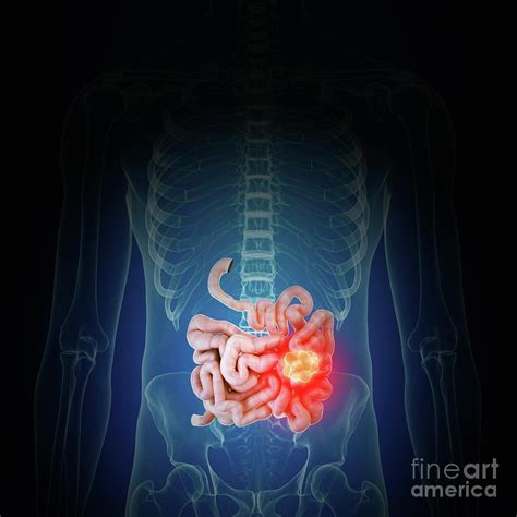 illustration of intestine cancer photograph by sebastian kaulitzki science photo library fine