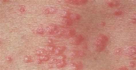 Rash On Inner Thigh Causes Itchy Male Female Treatment Treat Md