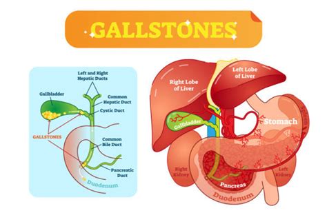Gastroenterologists In Orlando Share Info On Gallbladder Dysfunction