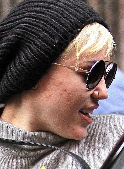 Celebrities Who Battle Acne Problems The Artistic Soul