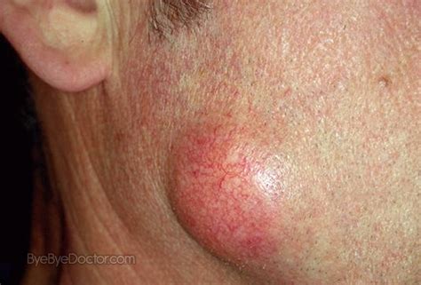 Epidermoid Cyst Pictures Treatment Removal Symptoms