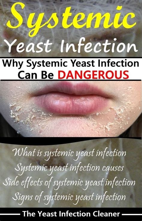 Signs Of Systemic Yeast Infection Yeast Infection Symptoms Yeast