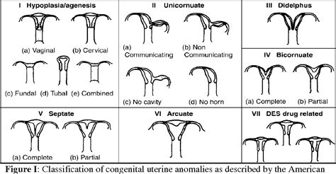 Figure I From Prevalence And Diagnosis Of Congenital Uterine Anomalies
