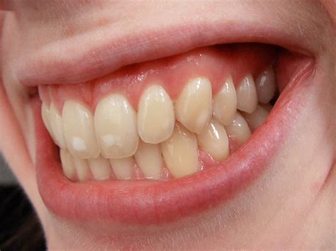What Are White Spots On Teeth And How To Remove Them