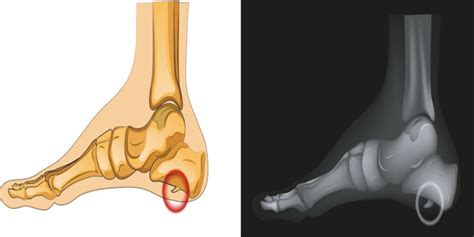 Bone Spurs Symptoms Causes And Diagnosis Baron Active