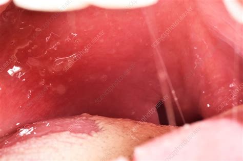 Infected Tonsil Quinsy Stock Image C0370847 Science Photo Library