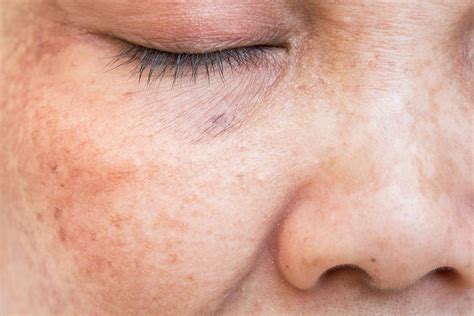 Sun Damage Face Treatment In Denver Colorado Orenda Medspa