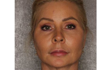 Facelift And Neck Lift By Azul Cosmetic Surgery And Medical Spa In Fort