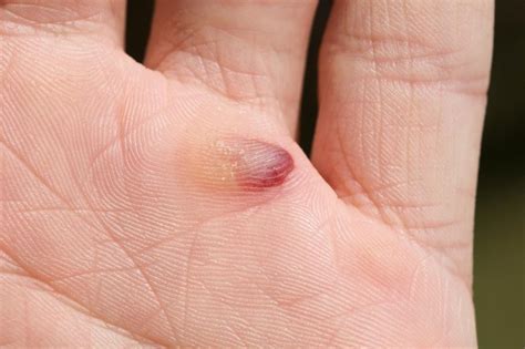How To Heal Blood Blisters Skirtdiamond27