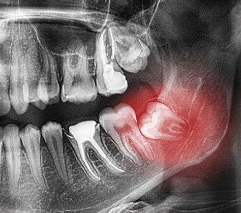 Is A Broken Wisdom Tooth Needed For Emergency Dentistry Home