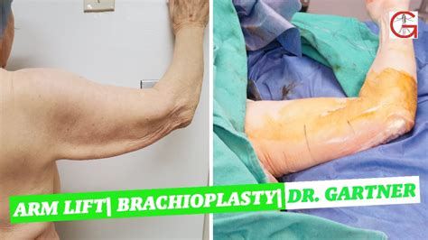 Brachioplasty Arm Lift Dr Gartner Youtube