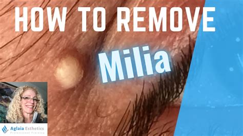 How To Remove Milia Under The Eyes Updates Youtube