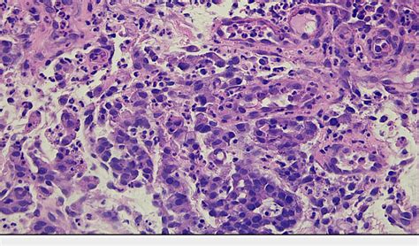 Histopathology Slide Showing Signet Cell Gastric Adenocarcinoma